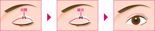 部分切開法