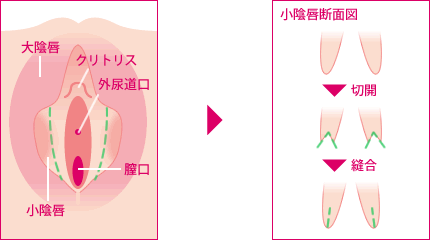 小陰唇縮小