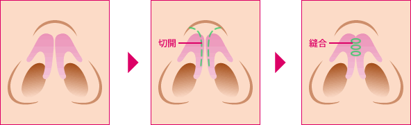 鼻尖軟骨切除